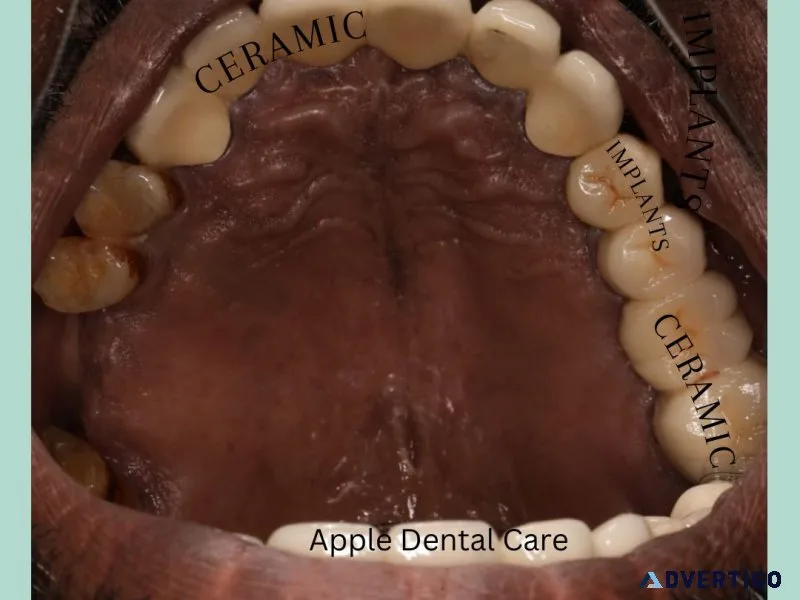 Dental implants in coimbatore