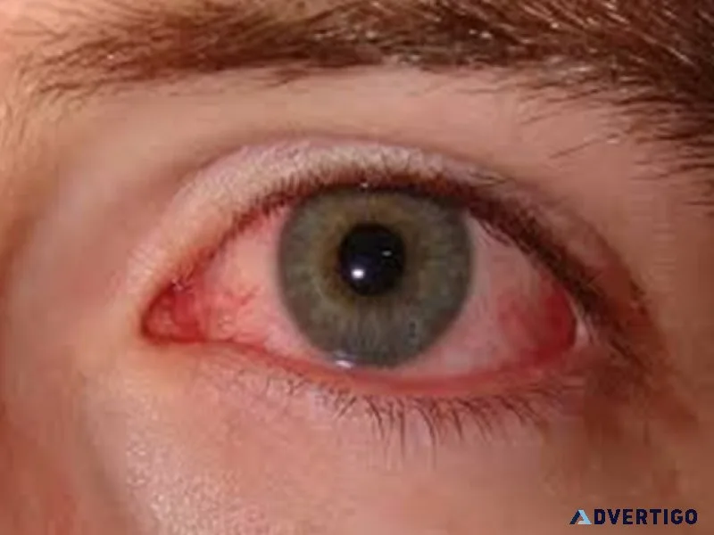 Best dry eye treatment