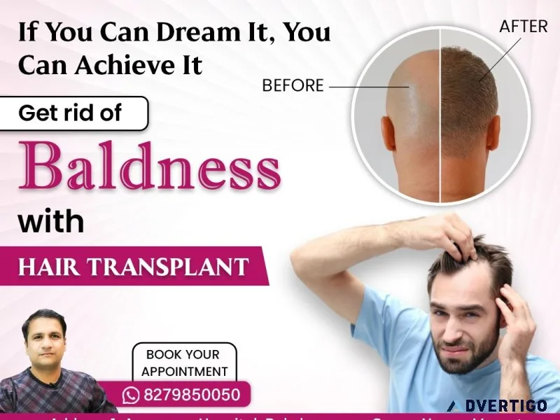 Best hair transplant in ncr