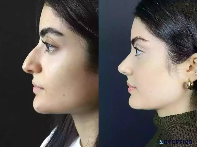 Best nose job in abu dhabi