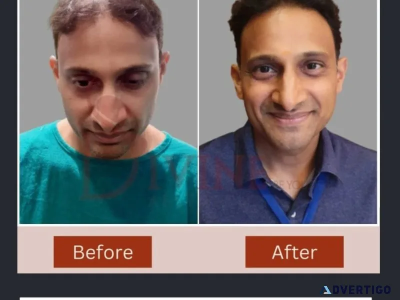 Hair transplant in delhi with best plastic surgeon