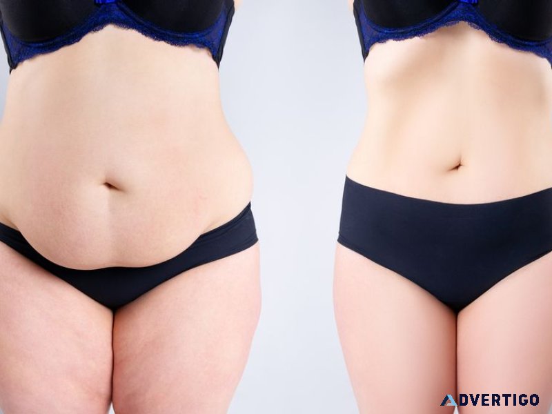 Best tummy tuck surgery in ahmedabad