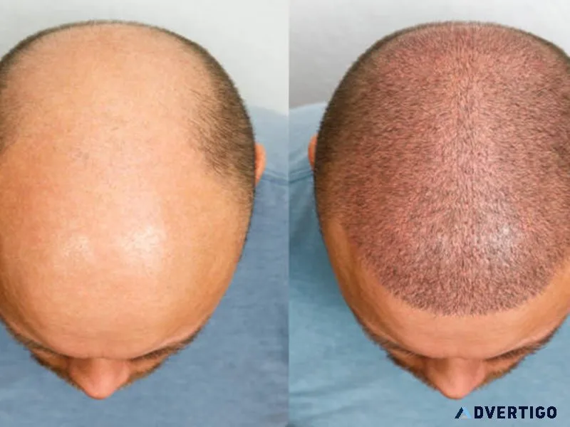 Best hair transplant surgery in ahmedabad