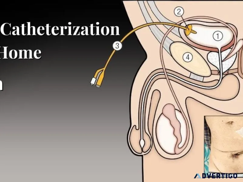 Suprapubic catheterization procedure: a comprehensive guide