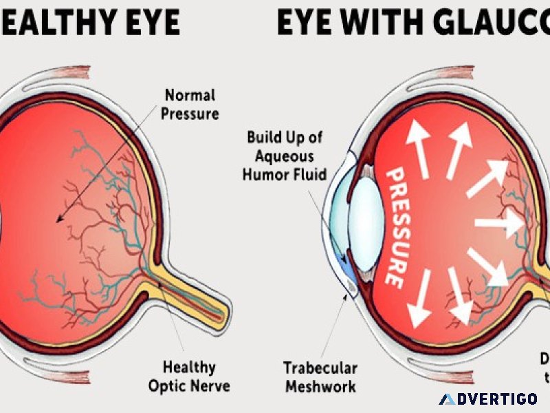 Glaucoma treatment in mumbai
