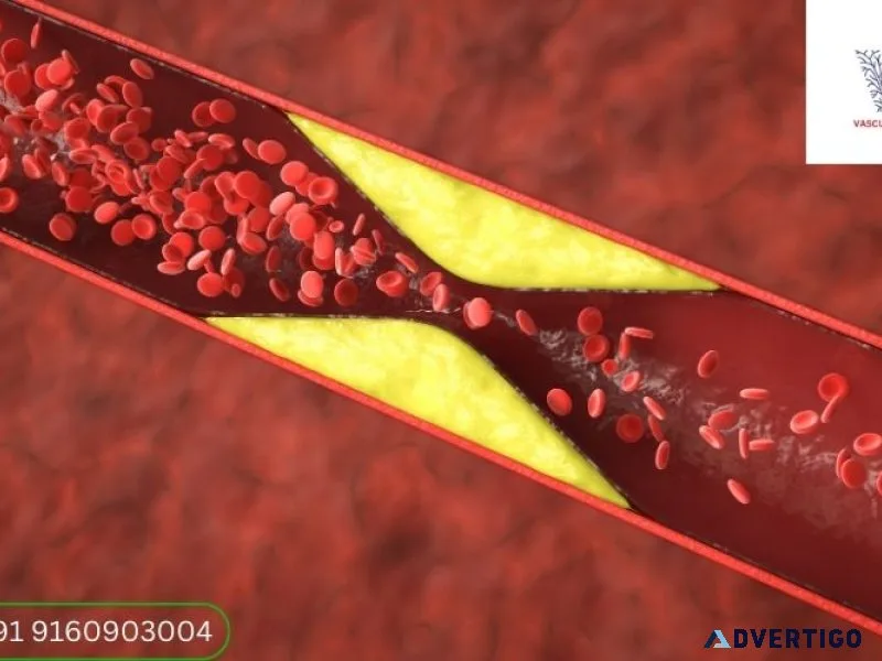 Peripheral artery disease in hyderabad