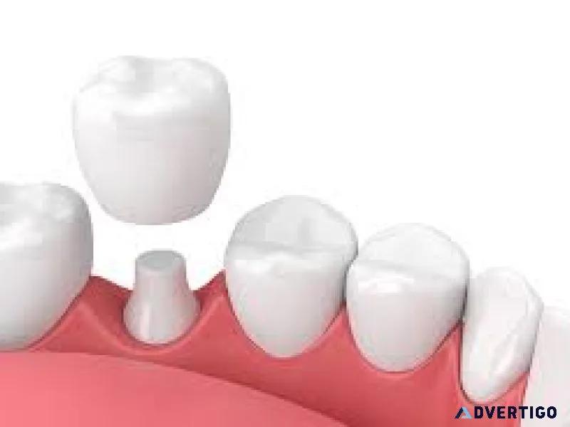 Dental crowns in abudhabi