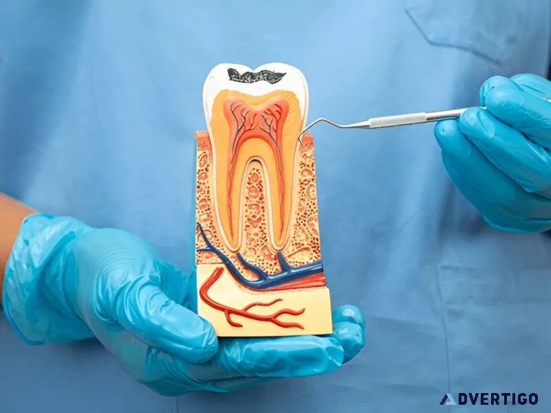 Root canal treatment in gurgaom