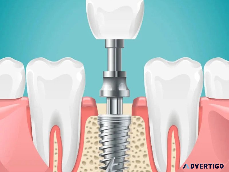 Dental implants cost per tooth – pricing & factors