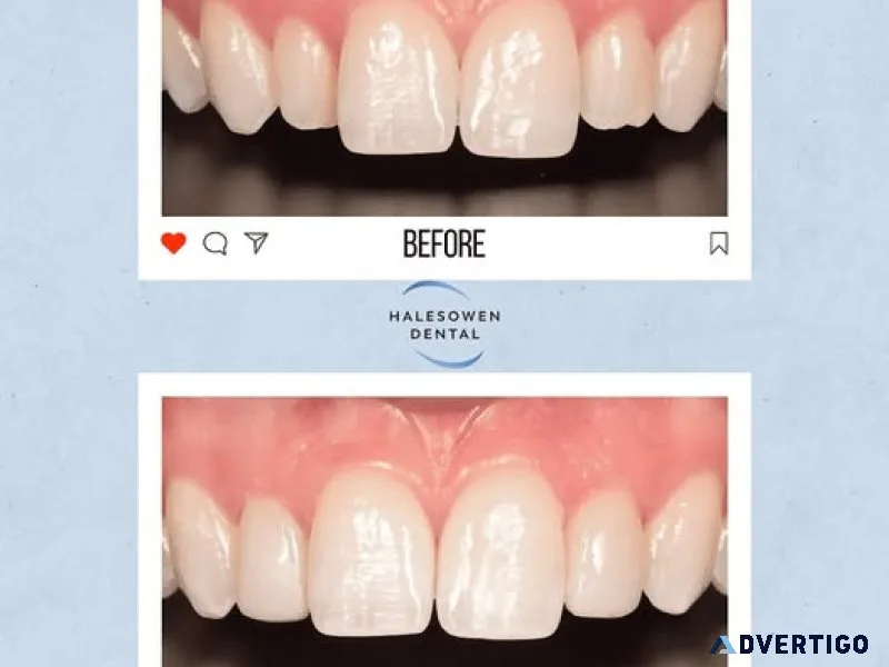 Searching for a better smile with invisalign birmingham?