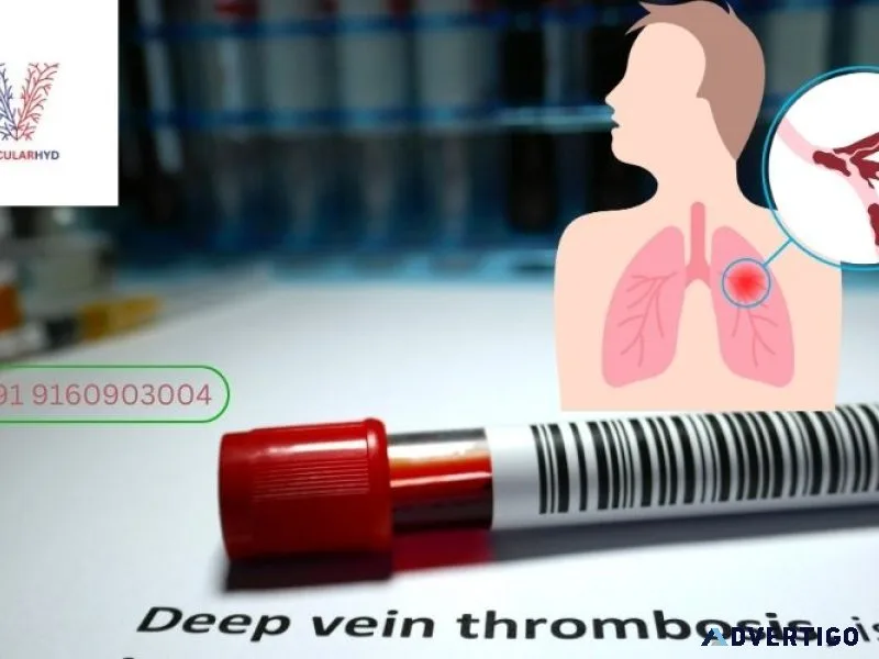 Best doctor for deep vein thrombosis in hyderabad | dr rahul ag