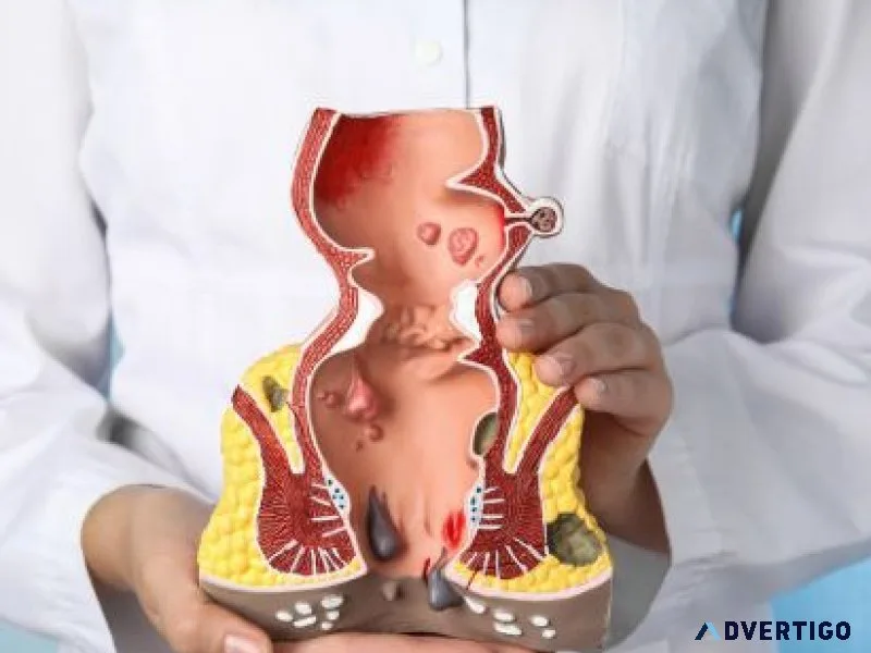 Kshar sutra treatment in lucknow for piles & fistula