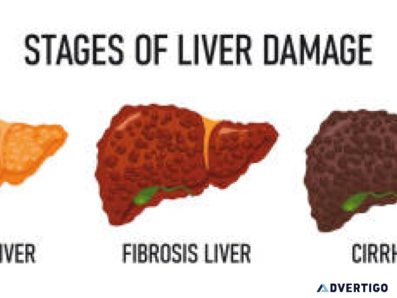I help fatty liver disease with out cumbersome gym exercises