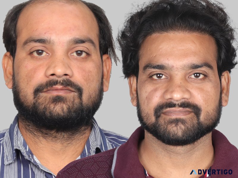 Fue hair transplant cost in india – what you need to know