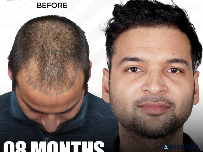 Qht hair transplant in noida
