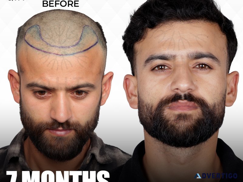 Cost of fue hair transplant in india: what to expect?