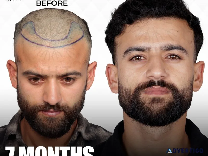 Cost of fue hair transplant in india: what to expect?