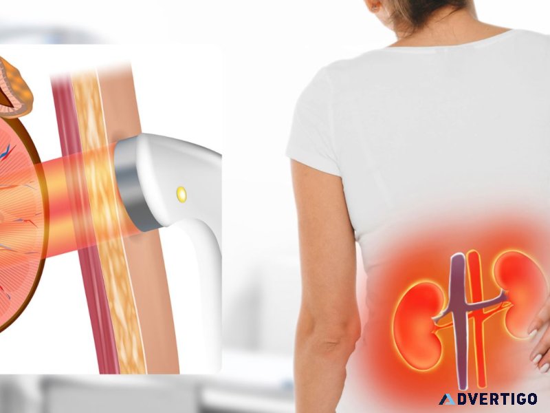 Painless kidney stone treatment without surgery - eswl by dr sk