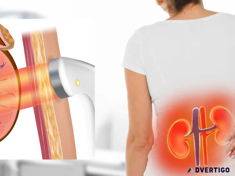 Painless kidney stone treatment without surgery - eswl by dr sk