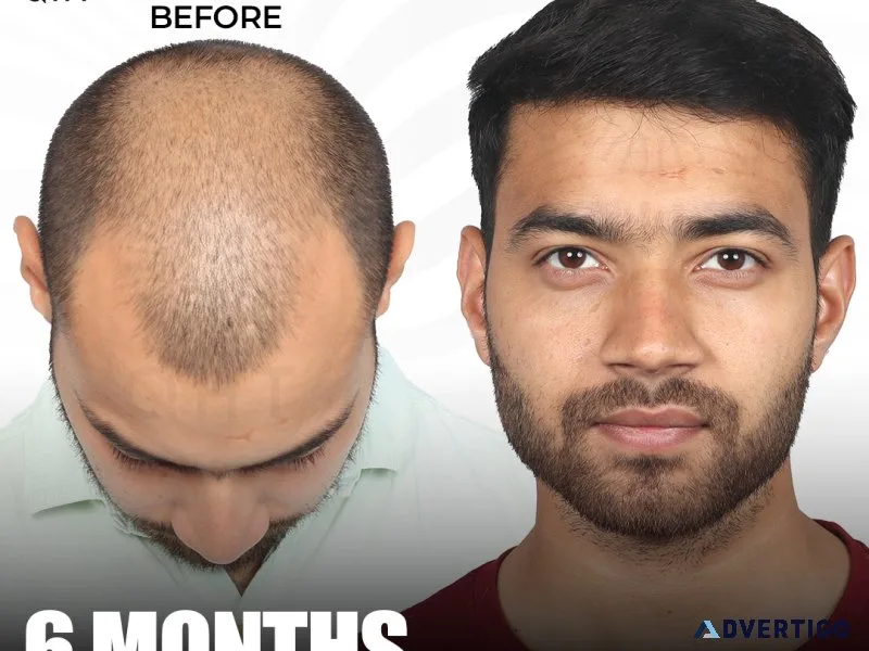 Know the best fue hair transplant cost at qht clinic
