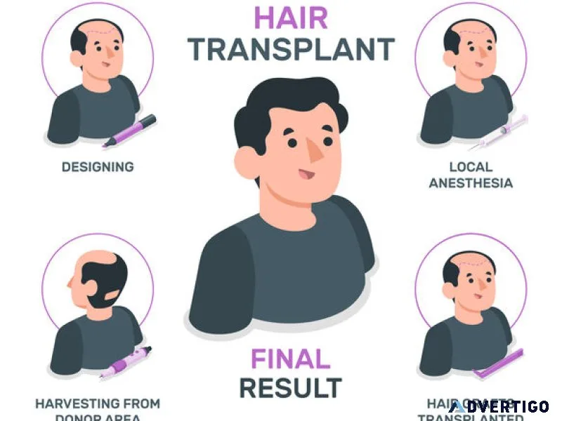 Hair transplant in india – qht clinic