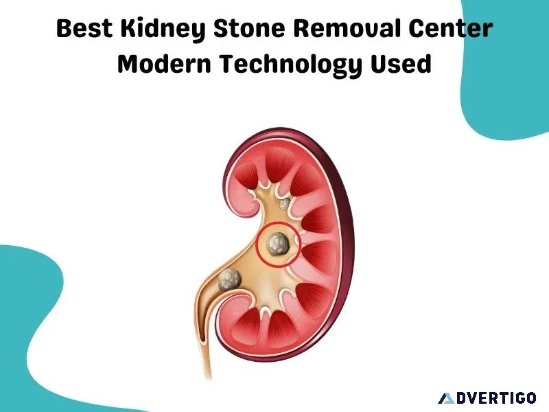 Best kidney stone removal center – modern technology used