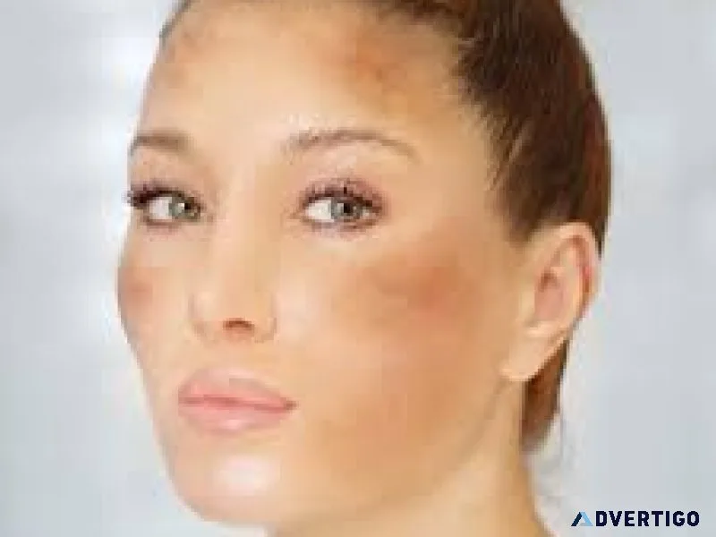 Best melasma treatment in thane – trusted solutions at dna royal
