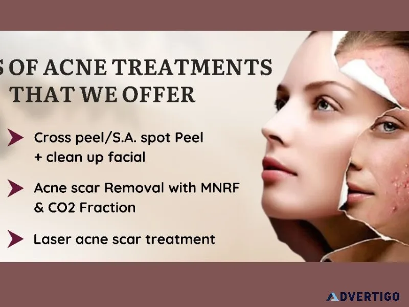 The best acne treatment in thane at dna royal aesthetic clinic