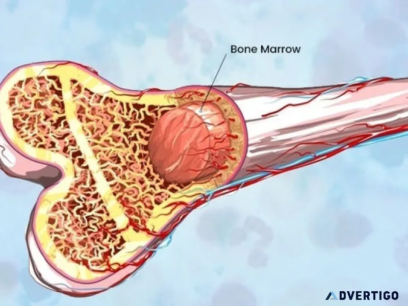 Bone Marrow Transplant Cost in India 
