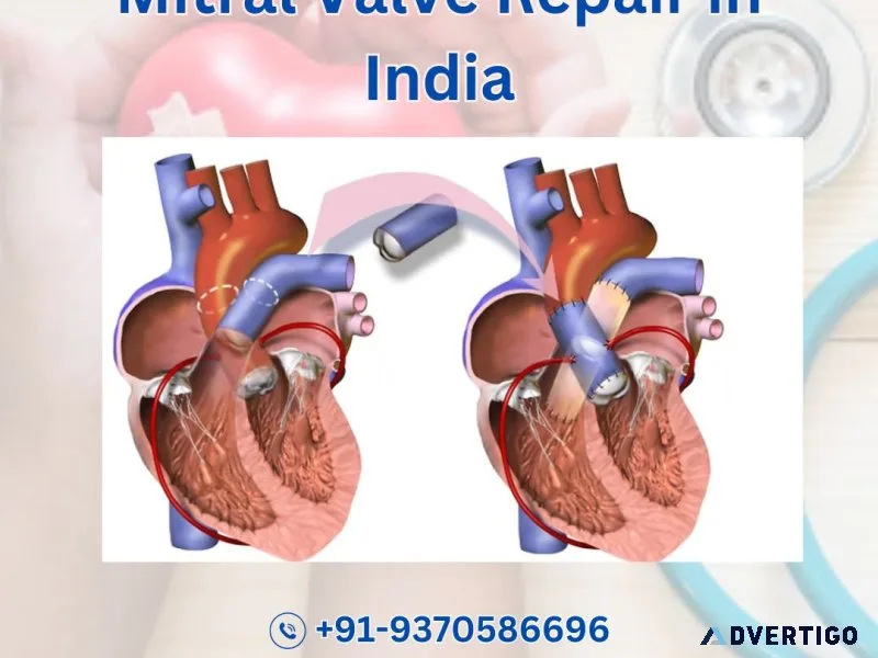 Mitral valve price in india