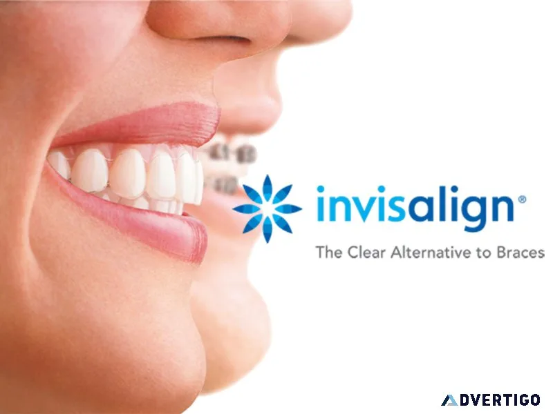 Invisalign center hyderabad – invisible braces experts