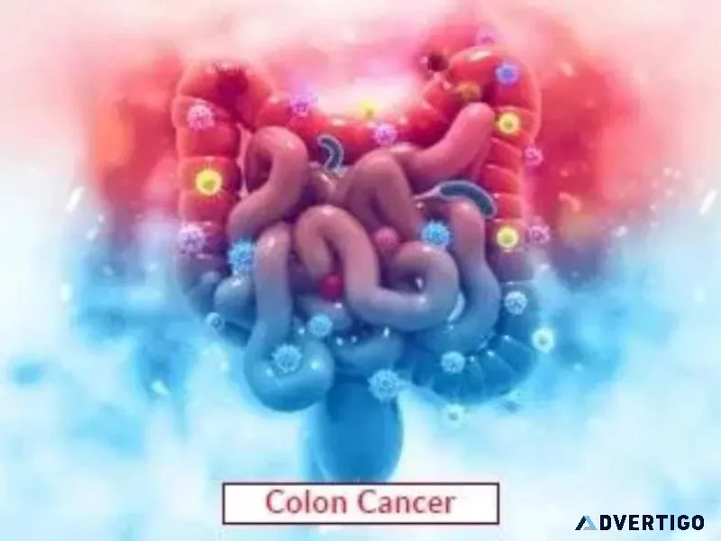 Colon cancer treatment
