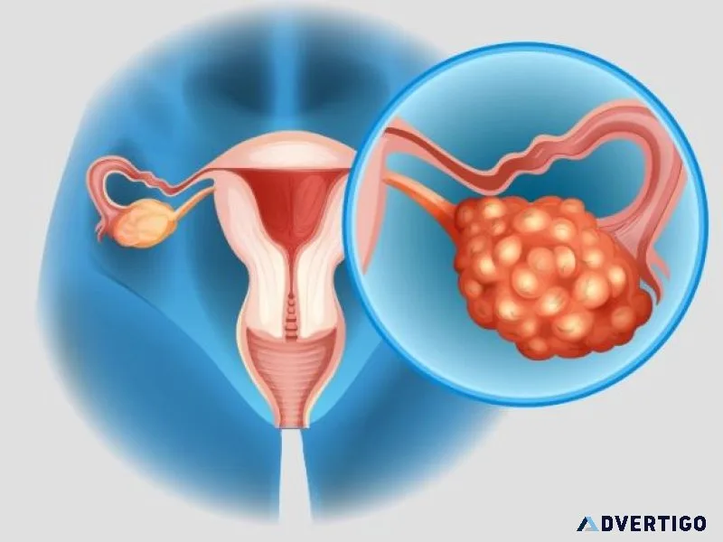 Effective pcod treatment in india: methods, clinics & costs