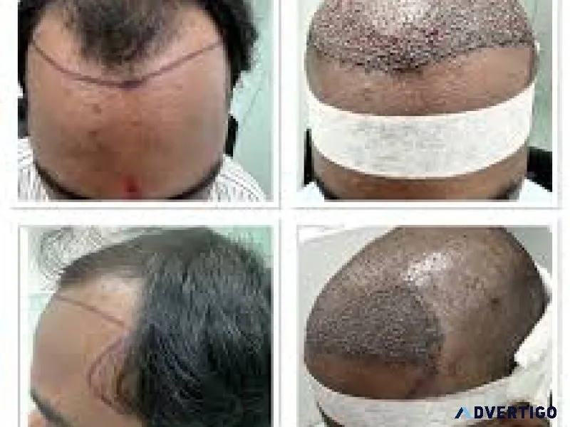 Fue hair transplantation in kondapur