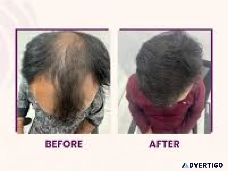 Fue hair transplantation in hitech city