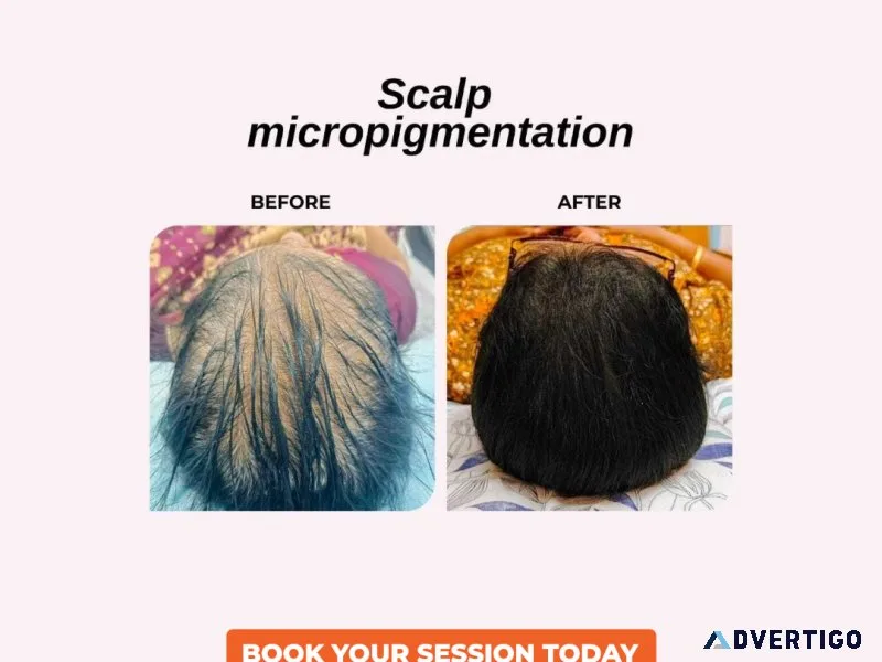 Best hair transplantation in kondapur