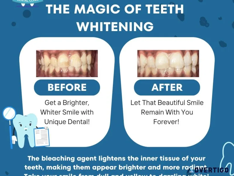 Expert dental cleaning & polishing in pimple saudagar
