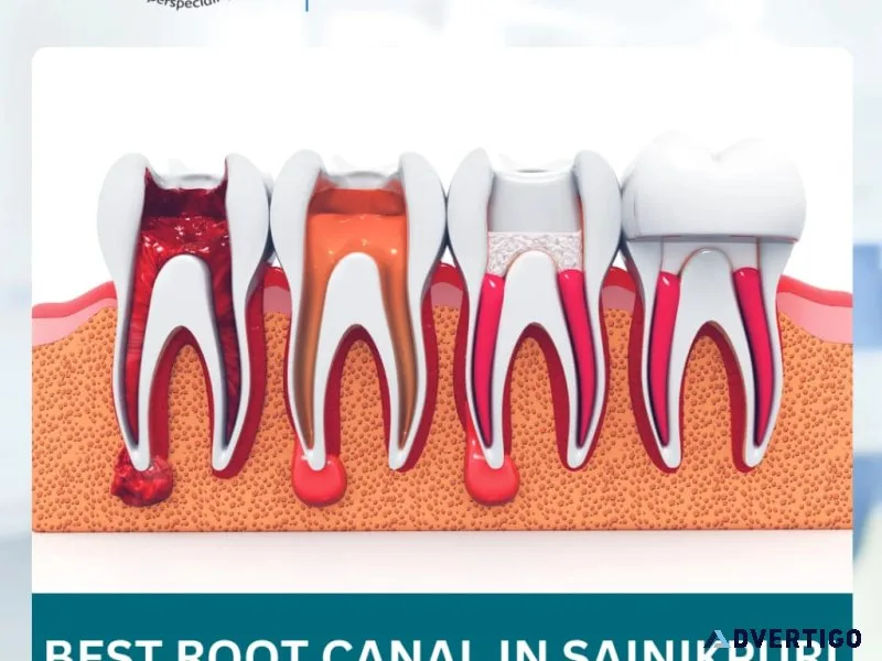 Top reasons to choose a root canal specialist over a general den