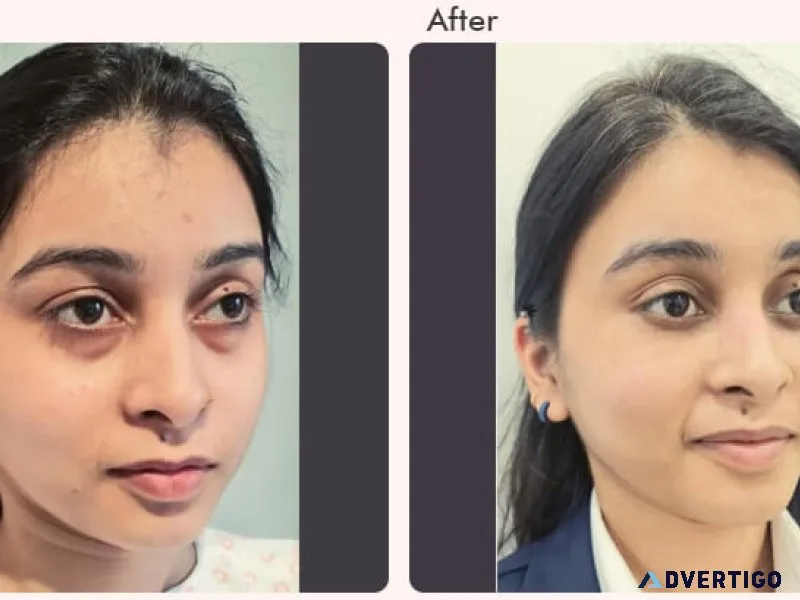 What is single eyelid or double eyelid surgery?