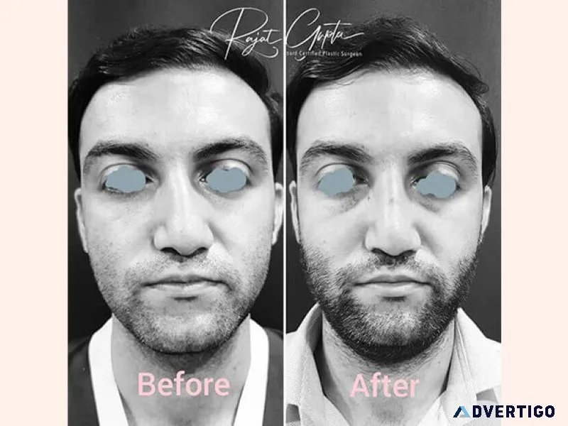 What are rhinoplasty grafts and why are they important?