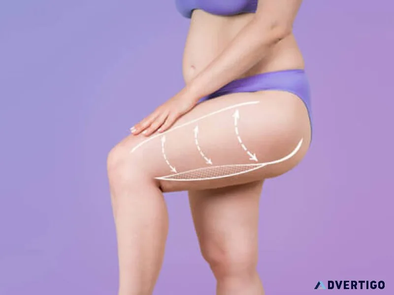 What is a thigh lift surgery?