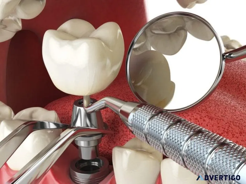 Dental implants in bangalore