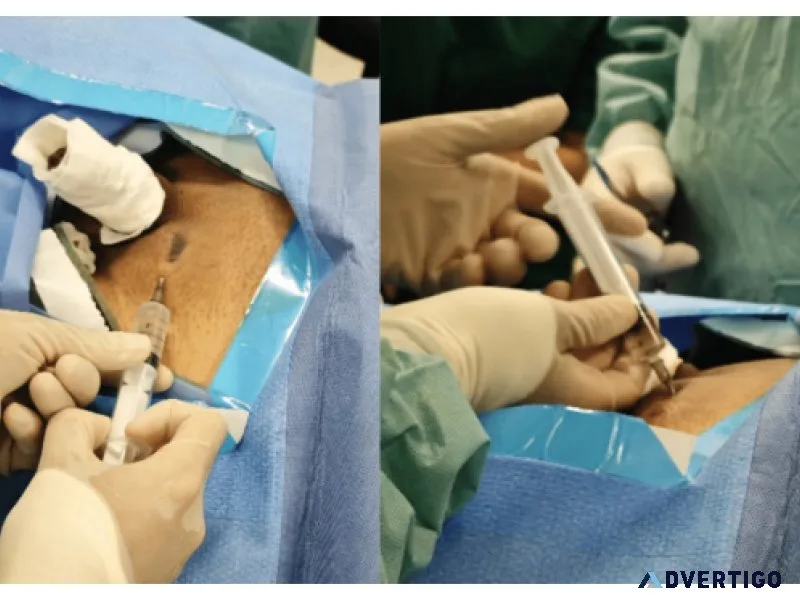 Affordable varicocele surgery cost in pune with expert care