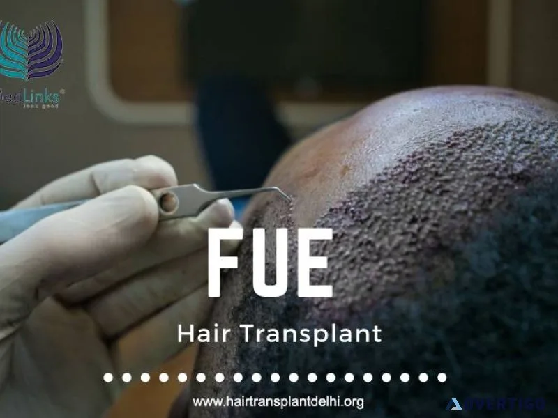 All you need to know about fue hair transplant | hair transplant