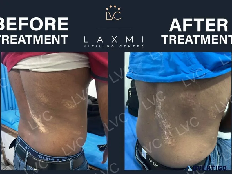 Side effect-free vitiligo treatment – laxmi vitiligo centre