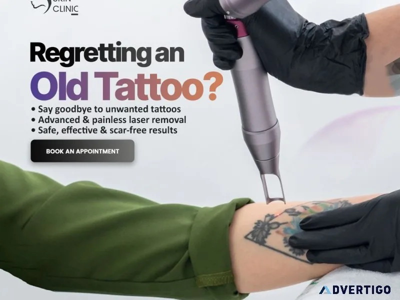 Tattoo removal in darbhanga | clear skin with laser skin clinic