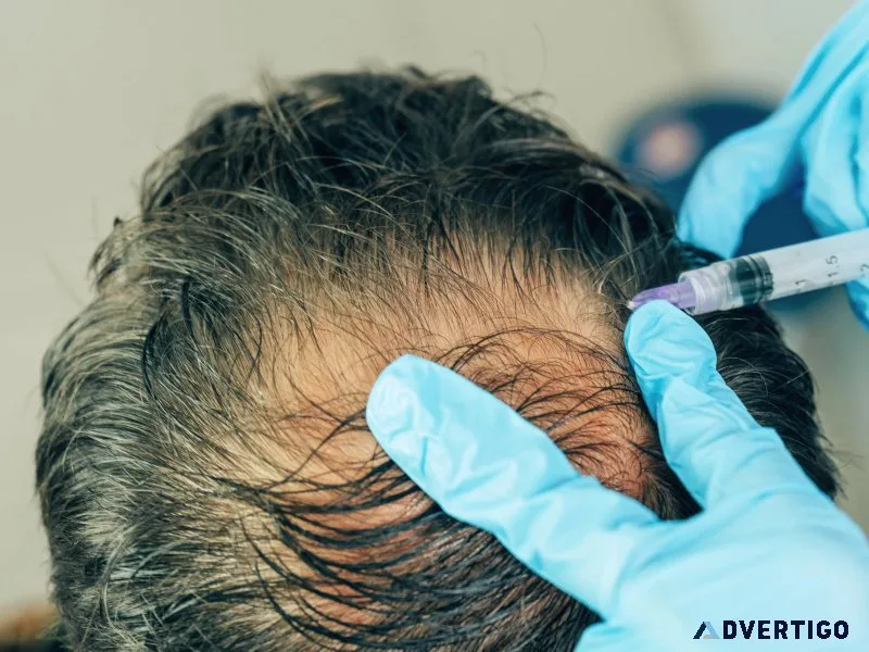 Vcare hair clinic – your trusted destination for advanced hair c