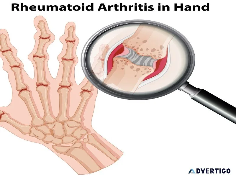 Natural rheumatoid arthritis treatment at nimba