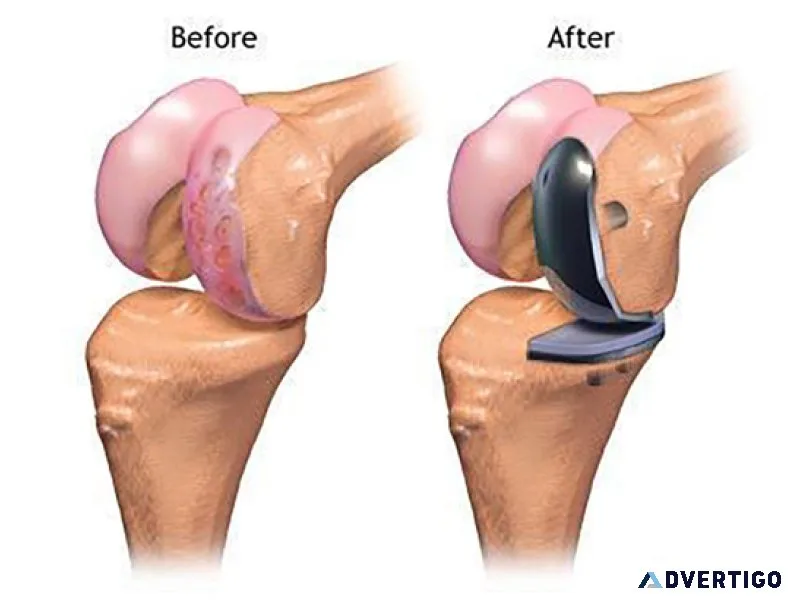 Partial knee replacement surgery in punjab | elite orthopaedics