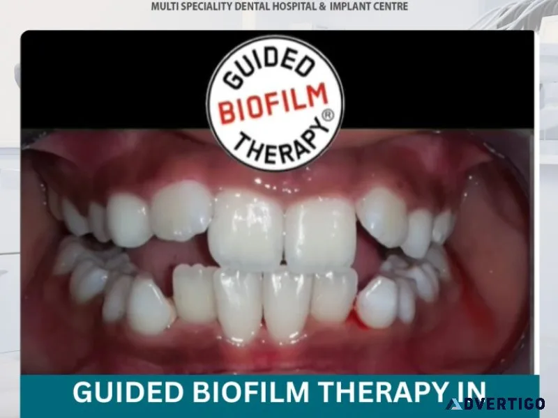 Affordable guided biofilm therapy cost in hyderabad